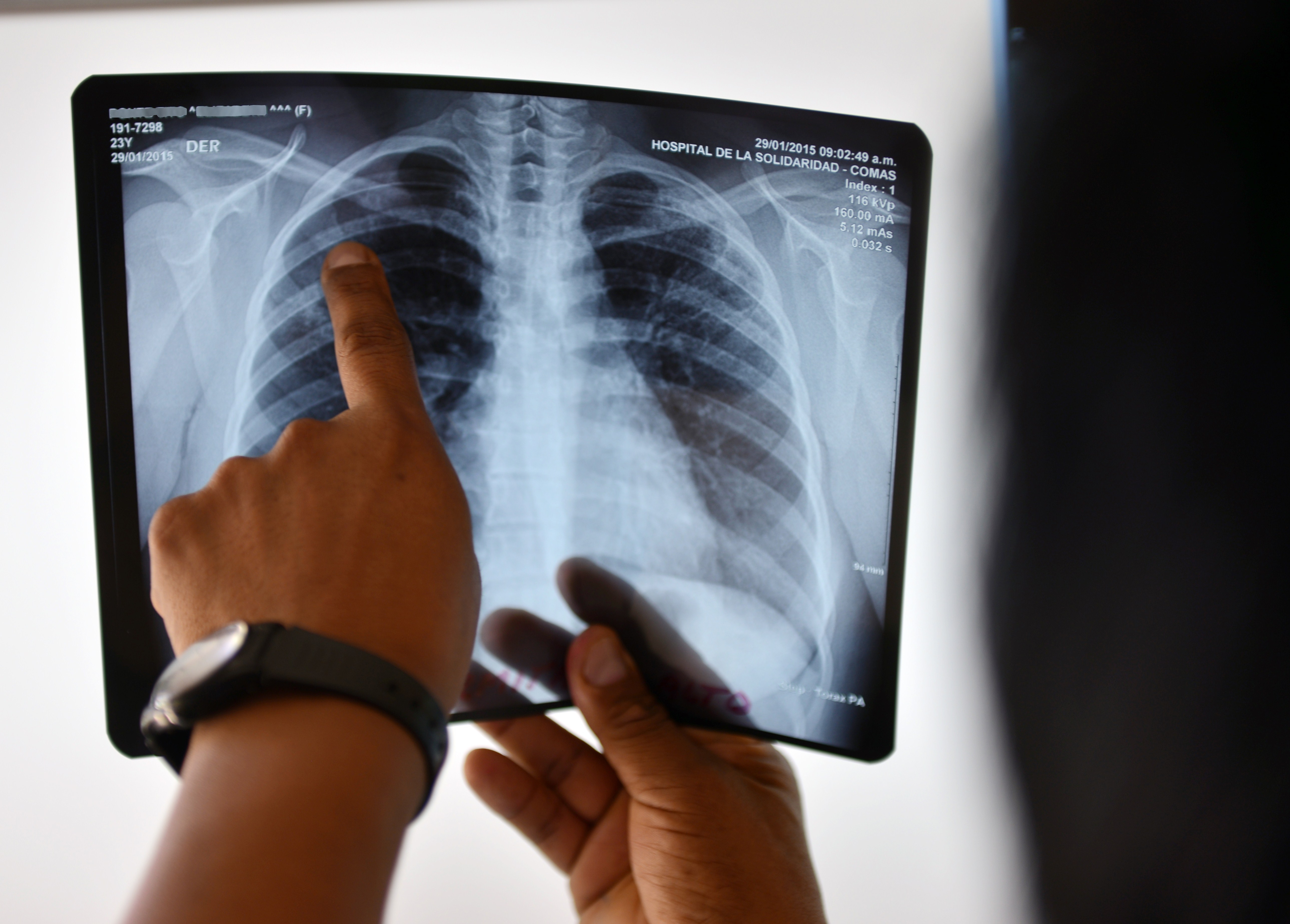 Tuberculosis: What you need to know | whas11.com