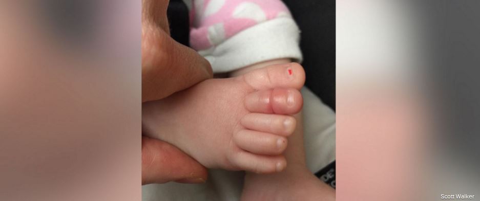 Dad's viral photo of baby's swollen toe raises awareness of rare ...